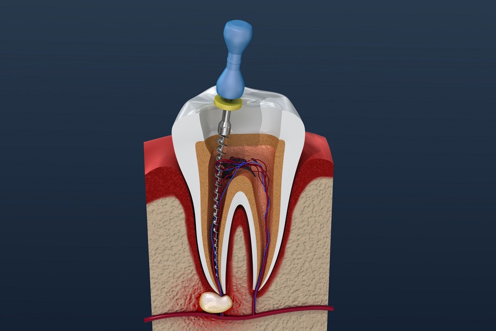 endodontie endodontie