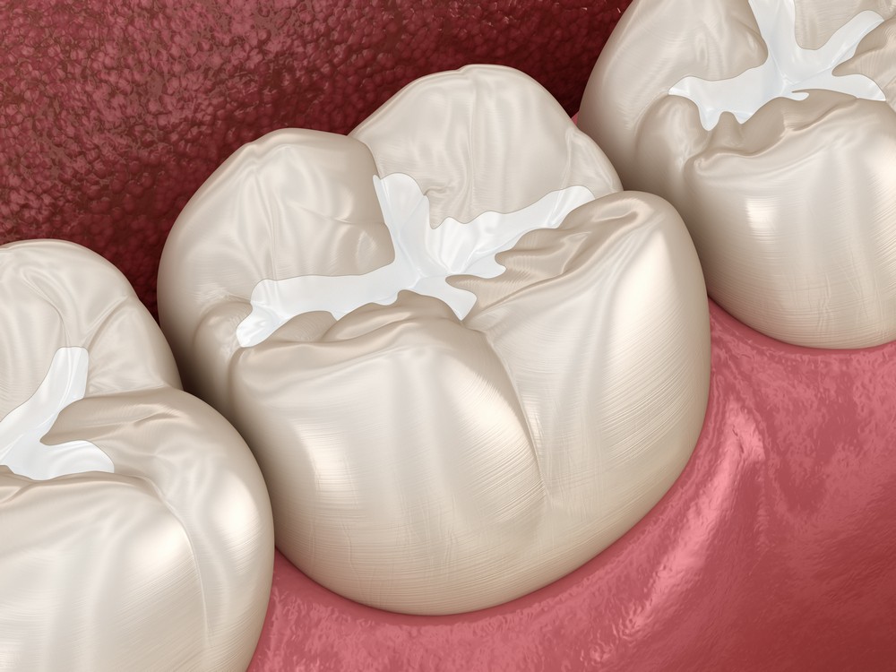 obturatia de canal dentar