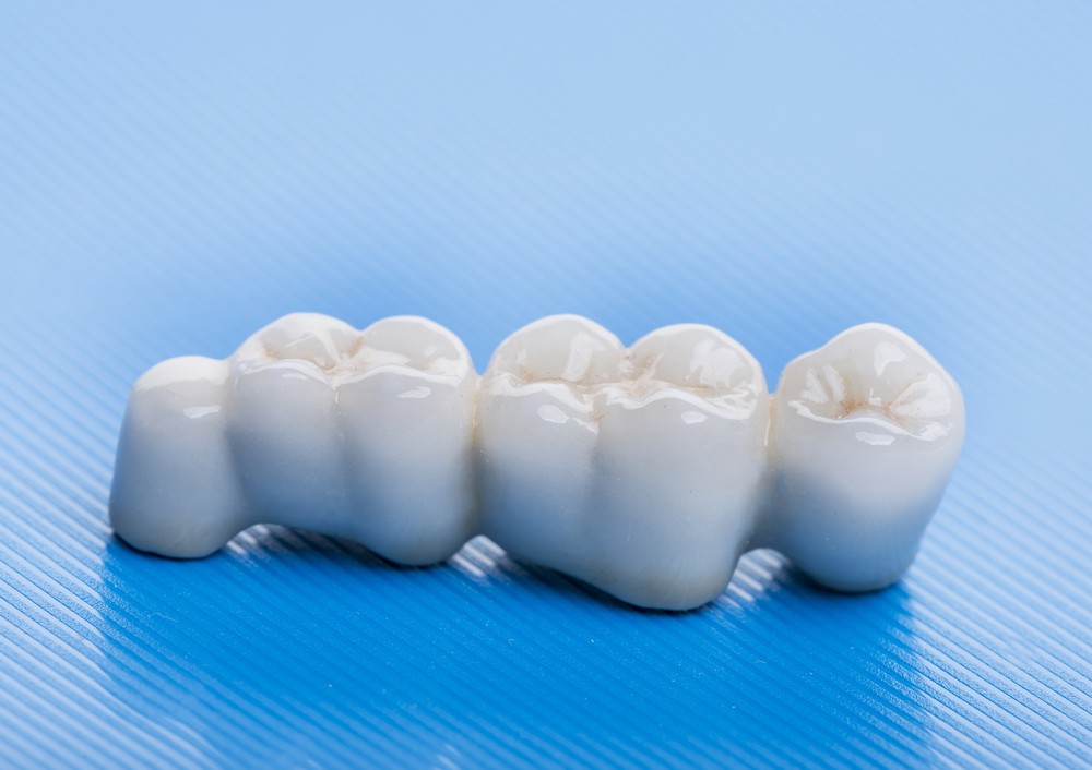 Implant 3d