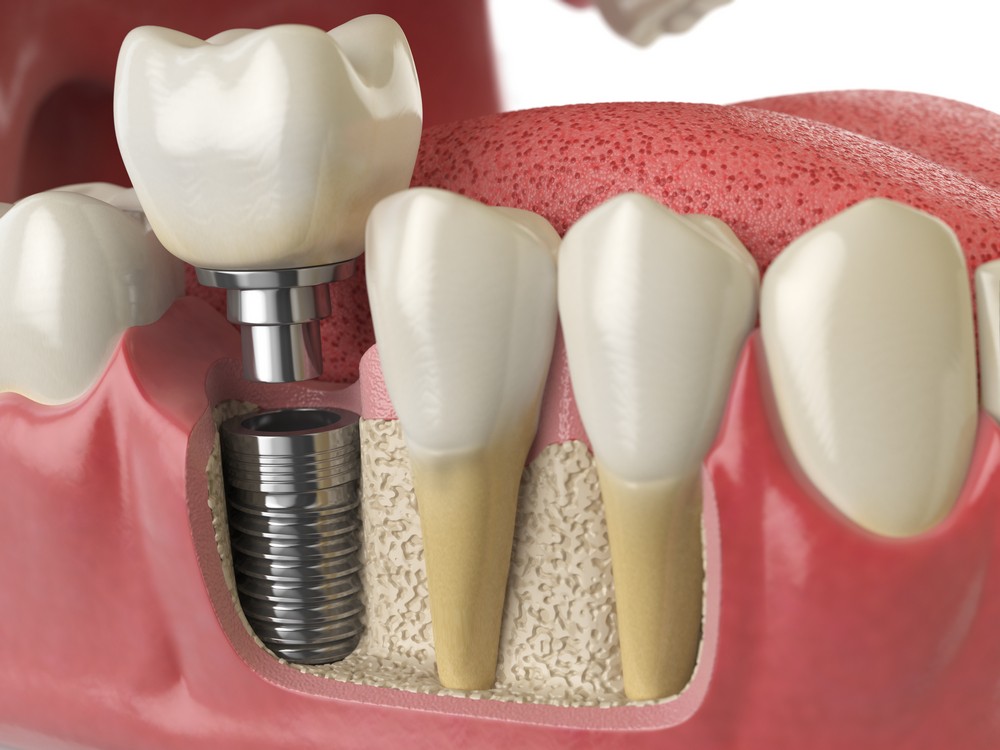 implant B&B