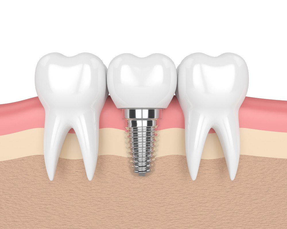implant dentar b&b