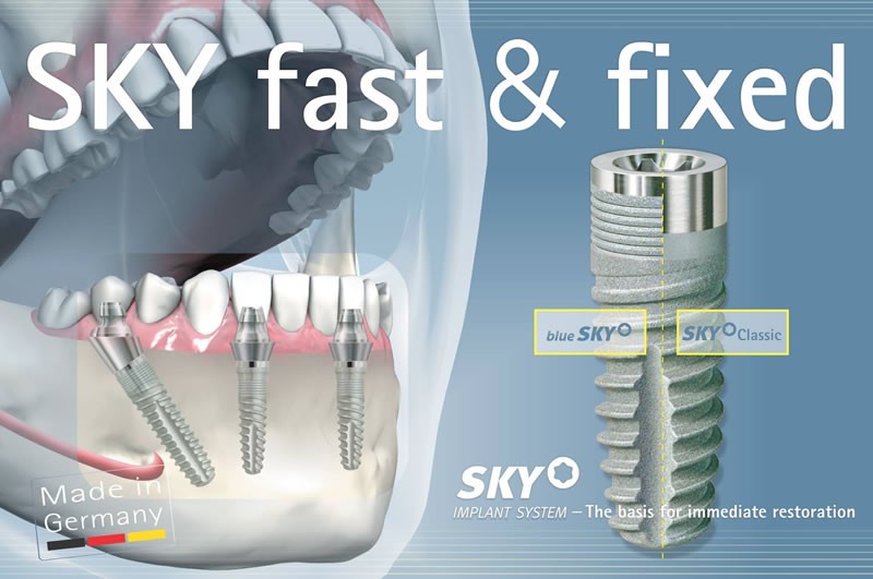 implant dentar fix